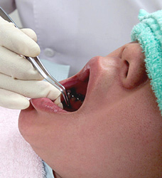 虫歯治療：イメージ